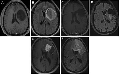 Case Report: “Aggressive” perioperative antiseizure medication prophylaxis in patients with glioma-related epilepsy at high risk of early postoperative seizures following awake craniotomy